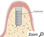 Implantation der künstlichen Zahnwurzel Implantation der künstlichen Zahnwurzel